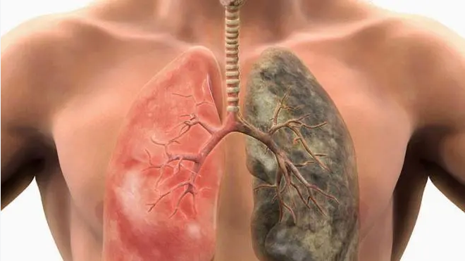 Κάπνισμα: Όλα τα συμπτώματα στους πνεύμονες εκτός από τον καρκίνο